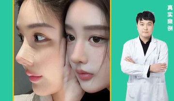妈生鼻效果图