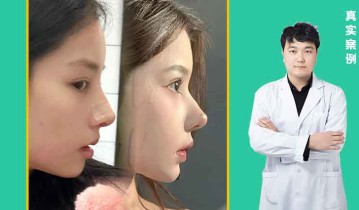 肋骨鼻效果图