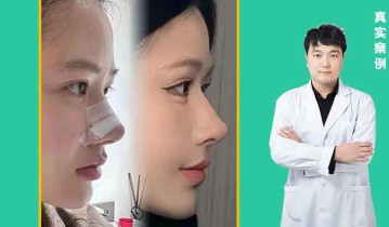 鼻综合效果图